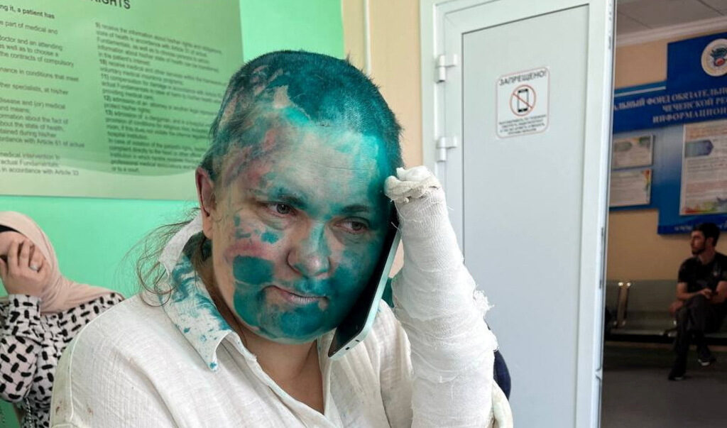 Чеченското следствие заведе дело за побоя над журналистката Милашина, тя е с черепно-мозъчна травма