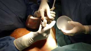 Париж може да финансира премахването на скандалните импланти за гърди