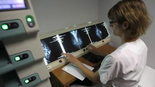 Особеност при една от 10 жени с рак на гърдата може да се окаже ключ към лечението й