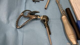 За пръв път в България момиче ще движи рамото и ръката си отново с 3D протеза